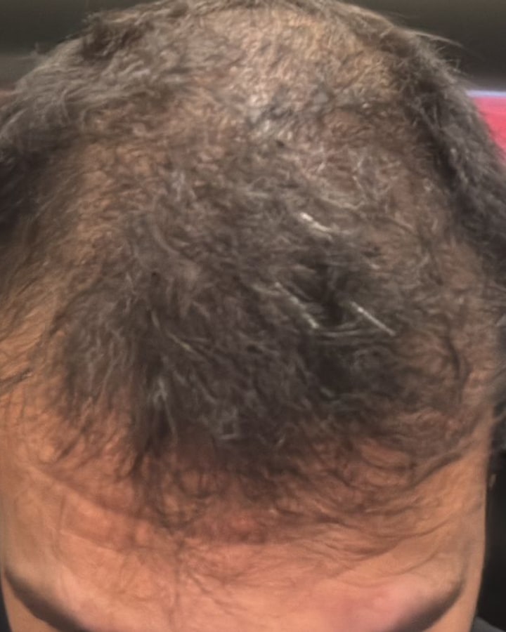 Vicente N. — densidade capilar na coroa: Início