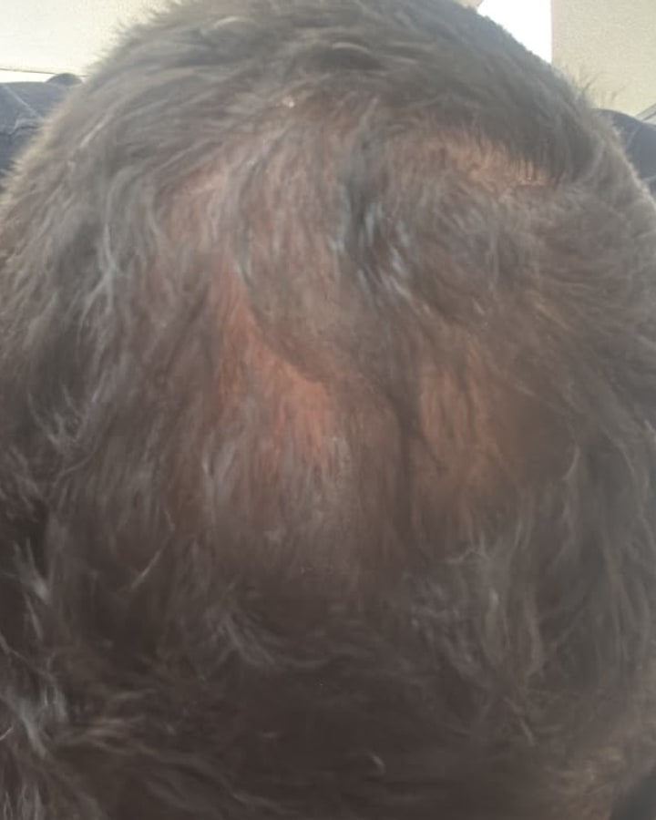 Vicente N. — densidade capilar na coroa: 3 meses