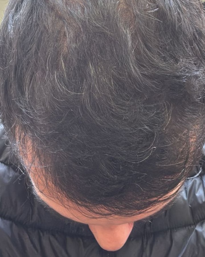 Vicente N. — densidade capilar na coroa: 6 meses